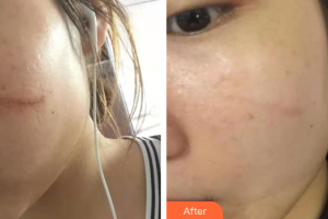 廣州尚美善造美容醫(yī)院陳靖汶整形價(jià)格表附點(diǎn)陣祛疤痕案例展示