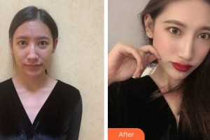 福州市第八人民醫(yī)院整形美容科張鴻超整形價(jià)格表附肋軟骨隆鼻案例展示