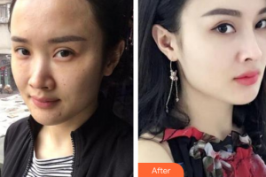 廣州尚美善造美容醫(yī)院李瓊整形價(jià)格表附熱瑪吉頸部體驗(yàn)案例展示