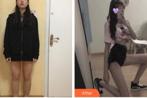 福州美萊華美美容醫(yī)院申峻昊整形價(jià)格表附大腿吸脂案例展示