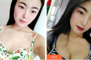 福州秀清醫(yī)療美容診所胡軍整形價(jià)格表附隆胸案例展示