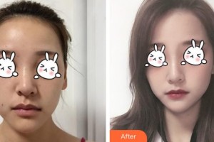 福州美萊華美美容醫(yī)院陳力楊整形價(jià)格表附下巴注射結(jié)合嗨體、線材改良嘟案例展示