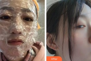 福州秀清醫(yī)療美容診所何卉整形價(jià)格表附激光美膚激光案例展示