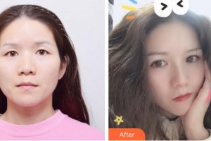 福州悅己醫(yī)療美容診所陳楓整形價(jià)格表附埋線雙眼皮+去脂肪案例展示