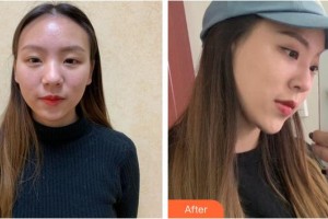 福州臺江醫(yī)院整形美容中心李文信整形價格表附隆鼻案例展示