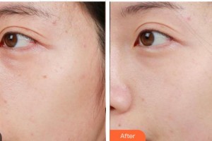 福州秀清醫(yī)療美容診所繆水云整形價格表附激光美膚祛斑案例展示