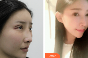 廣州基立嘉韓醫(yī)學(xué)整形美容醫(yī)院楊國(guó)華整形價(jià)格表附雙眼皮修復(fù)案例展示