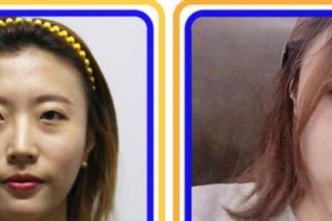 福州名韓整形美容醫(yī)院卓敬錫整形價(jià)格表附眼部綜合案例展示