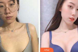 福州格萊美醫(yī)療美容醫(yī)院劉海整形價(jià)格表附隆胸案例展示