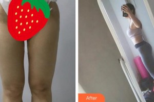 福州曙光整形美容醫(yī)院崔立龍整形價(jià)格表附吸脂案例展示