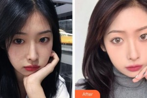 福州臺(tái)江醫(yī)院整形美容中心路世敏整形價(jià)格表附熱瑪吉案例展示