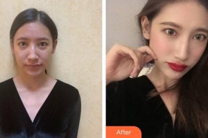 福州海峽美容醫(yī)院呂劍昇整形價(jià)格表附鼻部手術(shù)案例展示