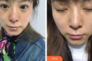 福州格萊美醫(yī)療美容醫(yī)院黃林玉整形價(jià)格表附超激光美膚祛斑案例展示