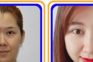 福州美貝爾醫(yī)療美容門(mén)診部羅德豐整形價(jià)格表附眼部綜合案例展示