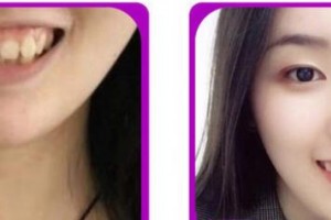 福州格萊美醫(yī)療美容醫(yī)院吳和峰整形價(jià)格表附隱形正畸案例展示