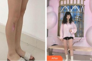 福州愛(ài)美爾整形美容醫(yī)院張洪濤整形價(jià)格表附增生疤痕案例展示