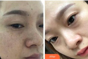 福州臺(tái)江醫(yī)院整形美容中心黃富梅整形價(jià)格表附雙激光美膚案例展示