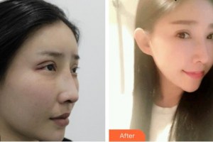 福州麥瑞整形美容醫(yī)院陳大正整形價(jià)格表附雙眼皮案例展示