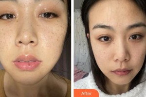 福州愛思特醫(yī)療美容醫(yī)院李宏整形價格表附超激光美膚祛斑案例展示