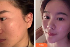 福州華窈渙美整形美容醫(yī)院林伯瀅整形價格表附激光美膚激光案例展示