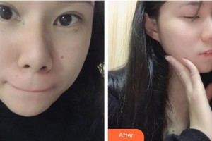 福州愛思特比華利整形美容醫(yī)院嚴玉秀整形價格表附雙激光美膚案例展示