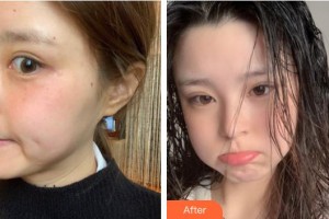 福州市第八人民醫(yī)院整形美容科羅莉整形價格表附激光美膚激光案例展示