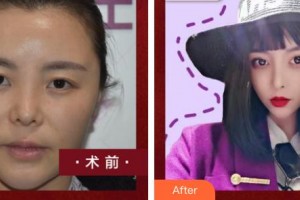 福州名韓整形美容醫(yī)院宋潤相整形價格表附鼻部手術案例展示