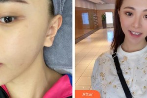 福州市鼓樓醫(yī)院整形美容中心鄭春燕整形價格表附激光祛斑案例展示