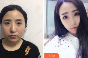 福州匯美整形美容醫(yī)院徐俊偉整形價格表附埋線提升提升案例展示