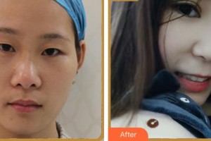 福州市第一醫(yī)院整形美容科郭國祥整形價格表附眼部多項案例展示