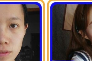 福州藝美醫(yī)療整形美容診所廖國良整形價格表附眼部手術 案例展示