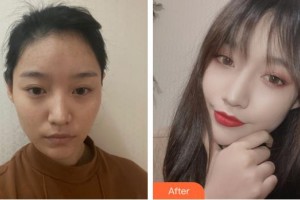 福州匯美整形美容醫(yī)院徐明宇整形價格表附射頻緊膚案例展示