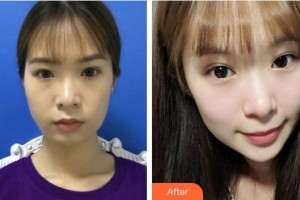 福州市第八人民醫(yī)院整形美容科柴天舉整形價格表附埋線提升案例展示