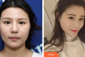福州藝美醫(yī)療整形美容診所張艷整形價格表附四代熱瑪吉案例展示