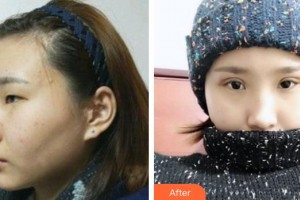 福州中聯(lián)美康整形美容醫(yī)院崔相哲整形價格表附眼部綜合案例展示