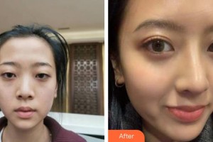 福州格萊美醫(yī)療美容醫(yī)院周秀峰整形價格表附鼻部手術(shù)案例展示