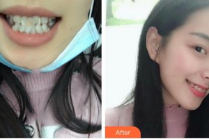 福州海峽美容醫(yī)院章至甫整形價格表附牙齒矯正案例展示