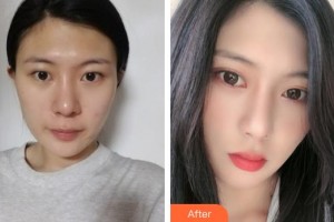 福州新時代醫(yī)療美容門診部都彥祿整形價格表附眼部案例展示