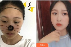 福州海峽美容醫(yī)院廖小飛整形價(jià)格表附植發(fā)案例展示