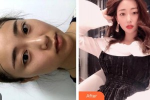 福州海峽美容醫(yī)院吳淑芬整形價(jià)格表附發(fā)際線案例展示