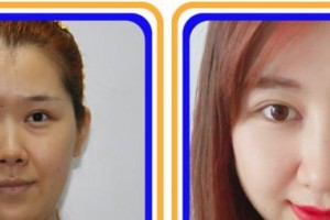 福州維多利亞醫(yī)療美容醫(yī)院陳玉葉整形價(jià)格表附眼部手術(shù)案例展示