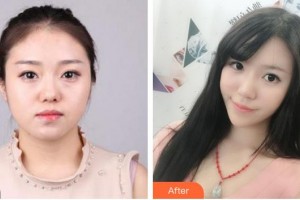 福州格萊美醫(yī)療美容醫(yī)院朱桂香整形價(jià)格表附埋線(xiàn)提升案例展示