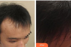 福州格萊美醫(yī)療美容醫(yī)院高欣整形價(jià)格表附植發(fā)案例展示