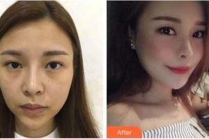 福州格萊美醫(yī)療美容醫(yī)院李橋蓮整形價(jià)格表附胸部案例展示