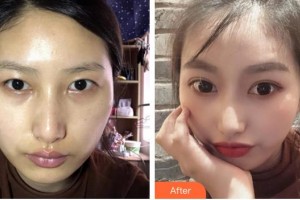 福州美貝爾醫(yī)療美容門診部趙棟材整形價(jià)格表附全切雙眼皮案例展示