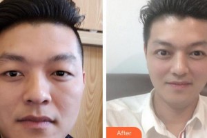 福州美貝爾醫(yī)療美容門診部張曉棠整形價(jià)格表附即變男神，無(wú)關(guān)痛癢案例展示