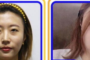 福州格萊美醫(yī)療美容醫(yī)院吳昌炎整形價(jià)格表附鼻部手術(shù)案例展示