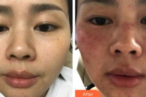 福州名韓整形美容醫(yī)院魏海艷整形價(jià)格表附激光美膚祛斑案例展示