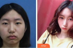 福州名韓整形美容醫(yī)院林偉整形價(jià)格表附美眼部手術(shù)案例展示