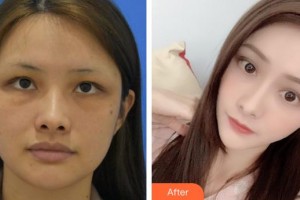 福州格萊美醫(yī)療美容醫(yī)院徐麗麗整形價(jià)格表附抗衰老案例展示